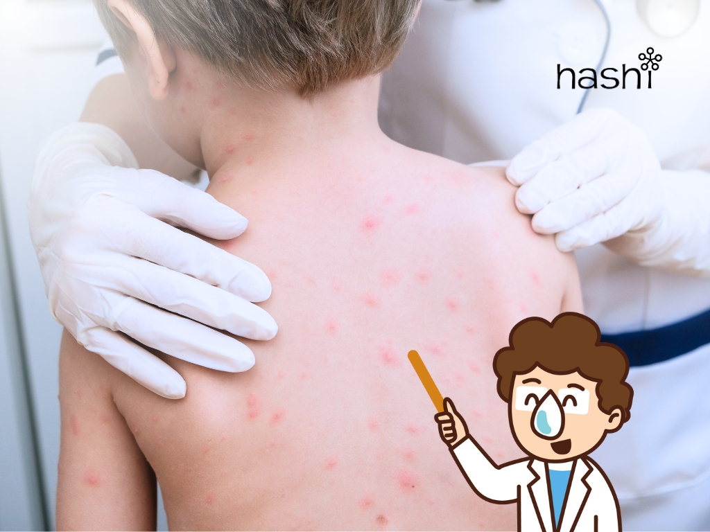 โรคที่มากับหน้าหนาว |โรคสุกใส