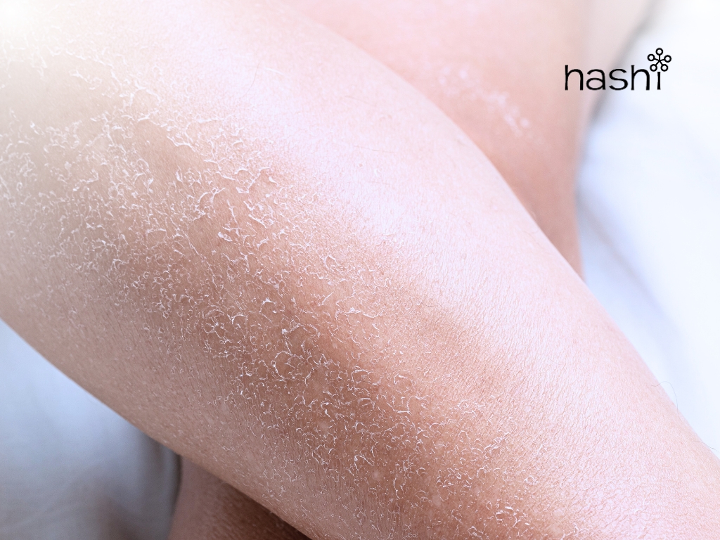 โรคที่มากับหน้าหนาว | ผิวหนังแห้ง